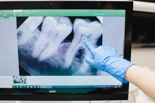 Dental Implants