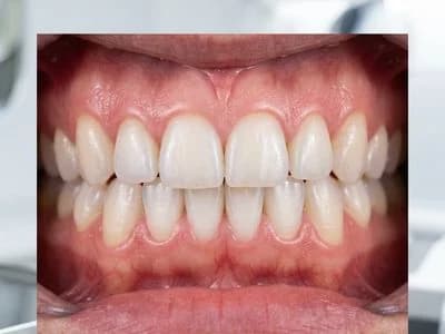 Bleeding Gums? Here Is What It Actually Means and How to Stop It
