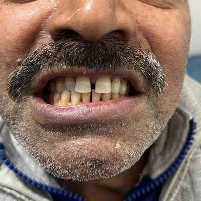 Smile Makeover Before Treatment - M.A. Dental Clinic Lucknow