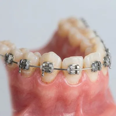 Braces & Aligners Before Treatment - M.A. Dental Clinic Lucknow