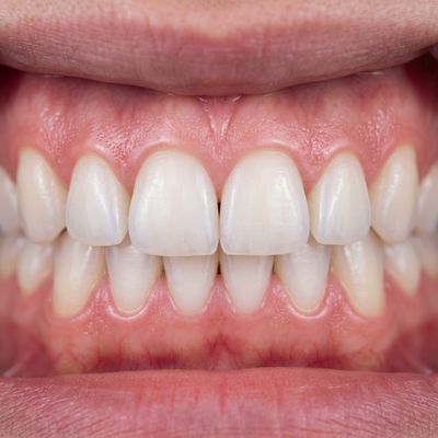 Gum Treatment After Treatment - M.A. Dental Clinic Lucknow