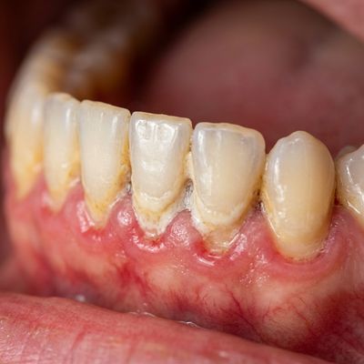 Gum Treatment Before Treatment - M.A. Dental Clinic Lucknow