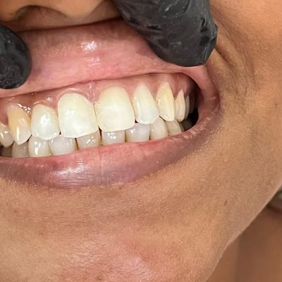 Porcelain Veneers After Treatment - M.A. Dental Clinic Lucknow