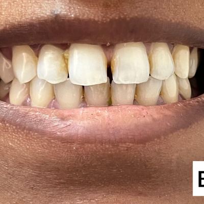 Porcelain Veneers Before Treatment - M.A. Dental Clinic Lucknow