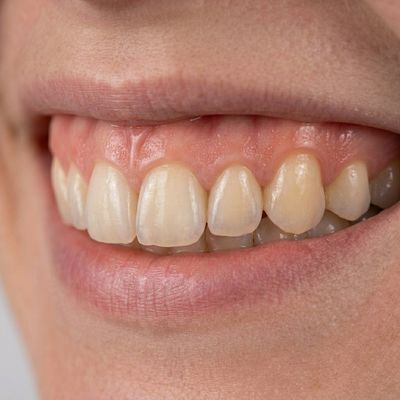 Dental Implants After Treatment - M.A. Dental Clinic Lucknow