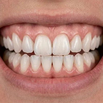 Teeth Whitening After Treatment - M.A. Dental Clinic Lucknow