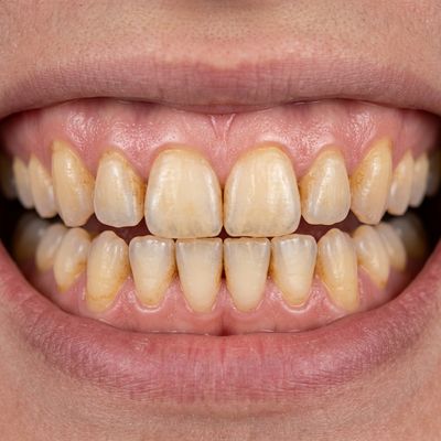 Teeth Whitening Before Treatment - M.A. Dental Clinic Lucknow