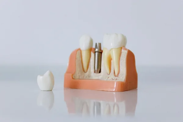 Root Canal Treatment